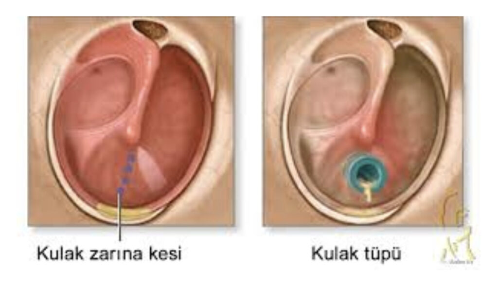 Kulak Tüpü Takılması Nedir? Kimlere Önerilir? 2026