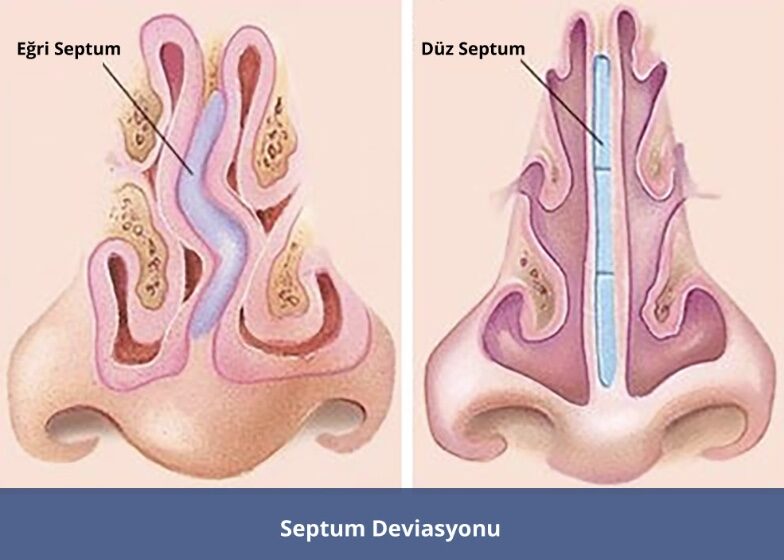 Septoplasti (Burun Eğriliği Ameliyatı) Nedir? Rahat Bir Nefese Giden Yol 1